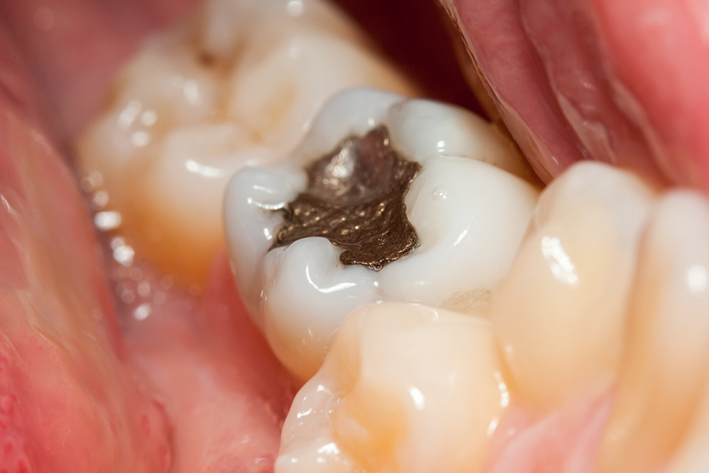 What is the difference between white and silver fillings?