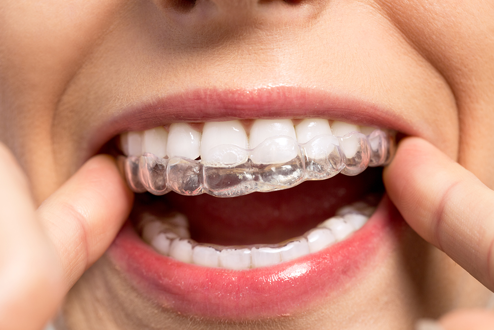 Things you Probably Never Knew About Invisalign