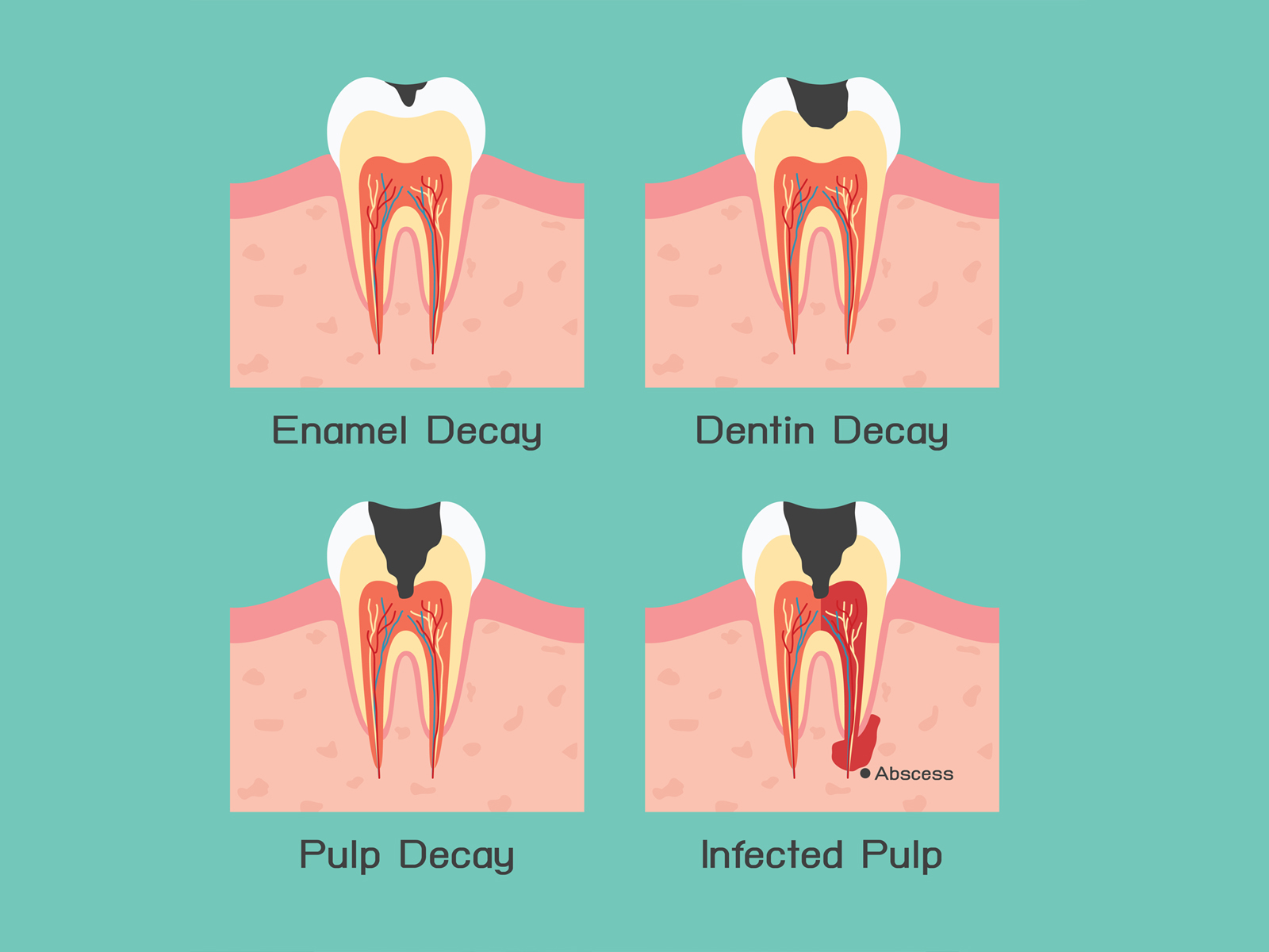 How can I cure my tooth decay?
