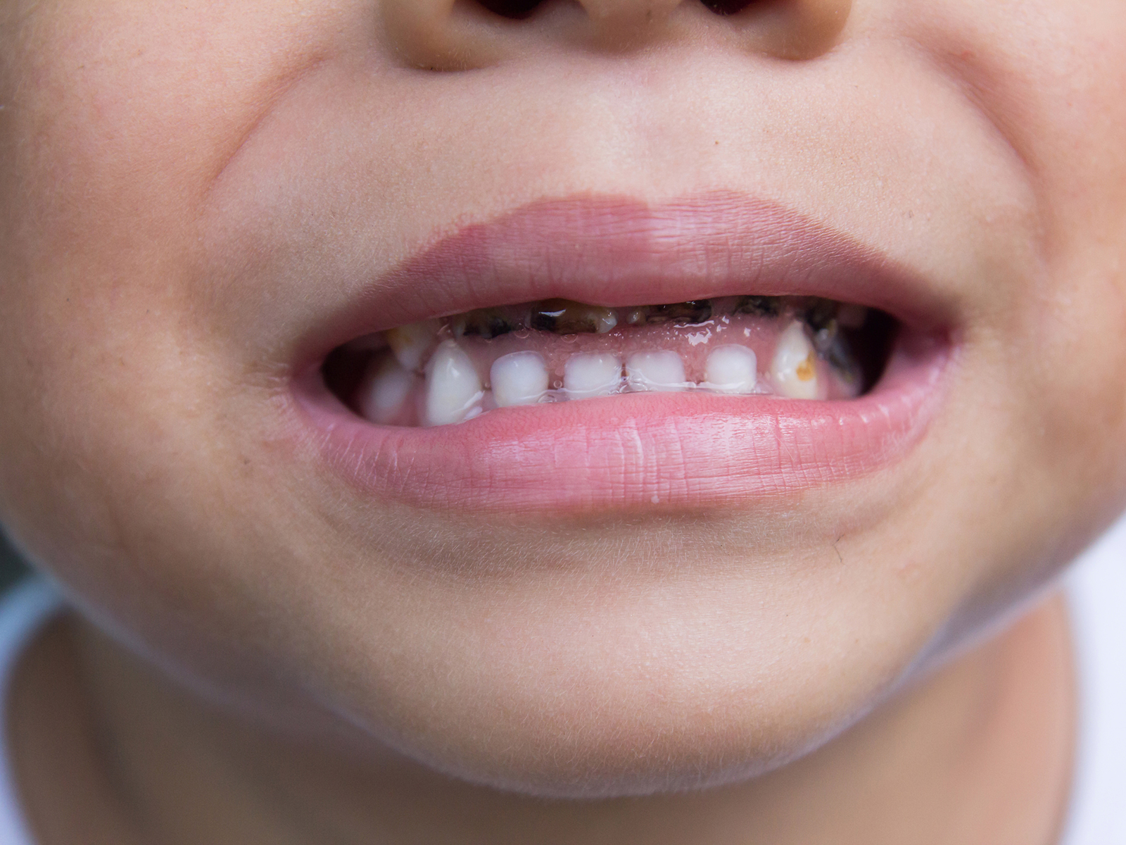 Tips To Prevent Tooth Decay In Kids