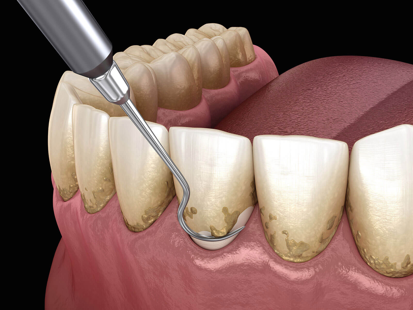 Importance of Scaling And Root Planing In Preventing Gum Disease