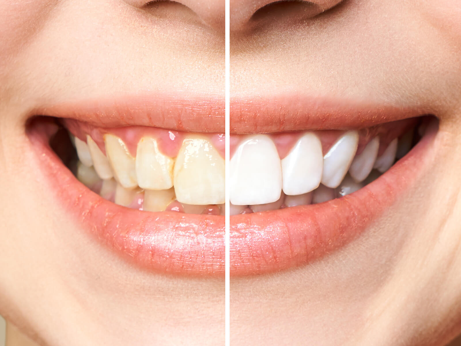 A Comprehensive Guide to Maintaining Teeth Whitening Results