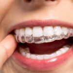 What To Expect After Completing Invisalign Treatment