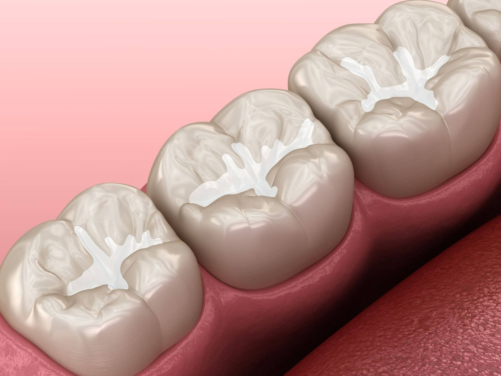 What Is The Best Age To Get Dental Sealants?