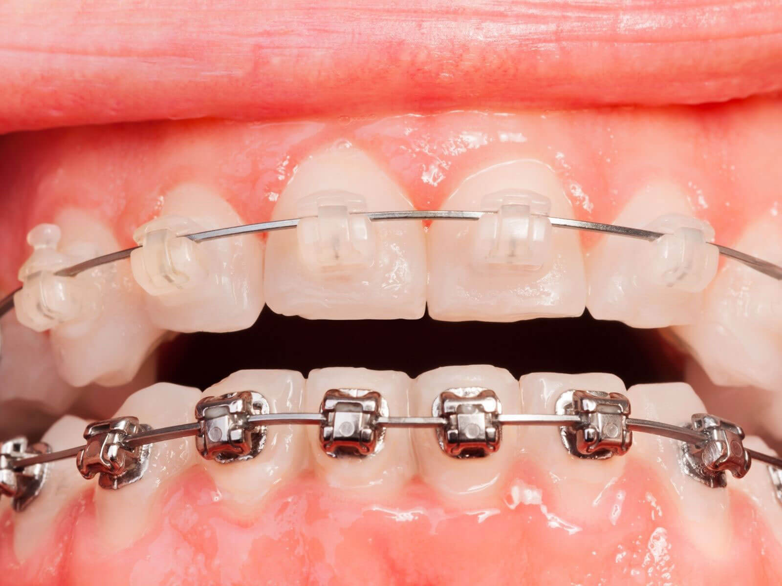 7 Clear Signs That You Might Need Braces