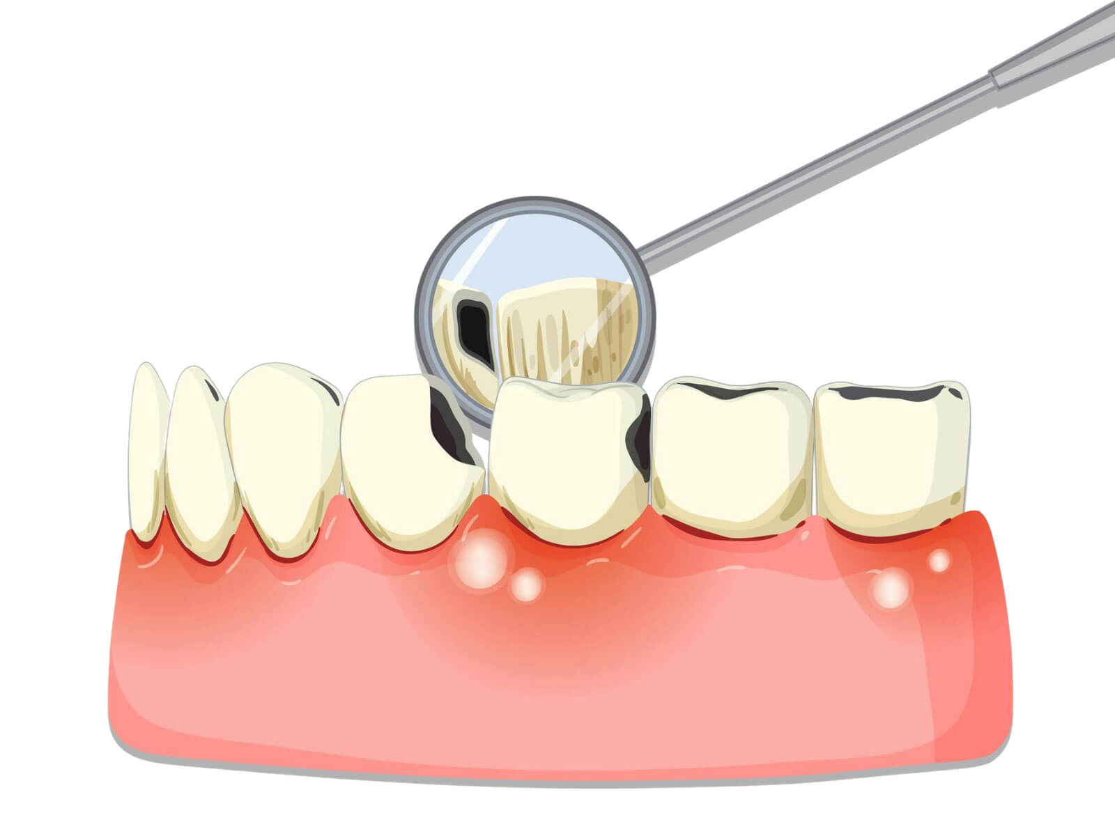 Can You Get a Cavity Under a Filling?