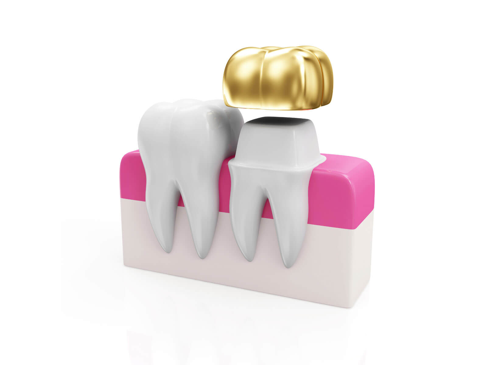 Dental Crown Procedure: 2-Visit vs Same-Day Crowns Explained