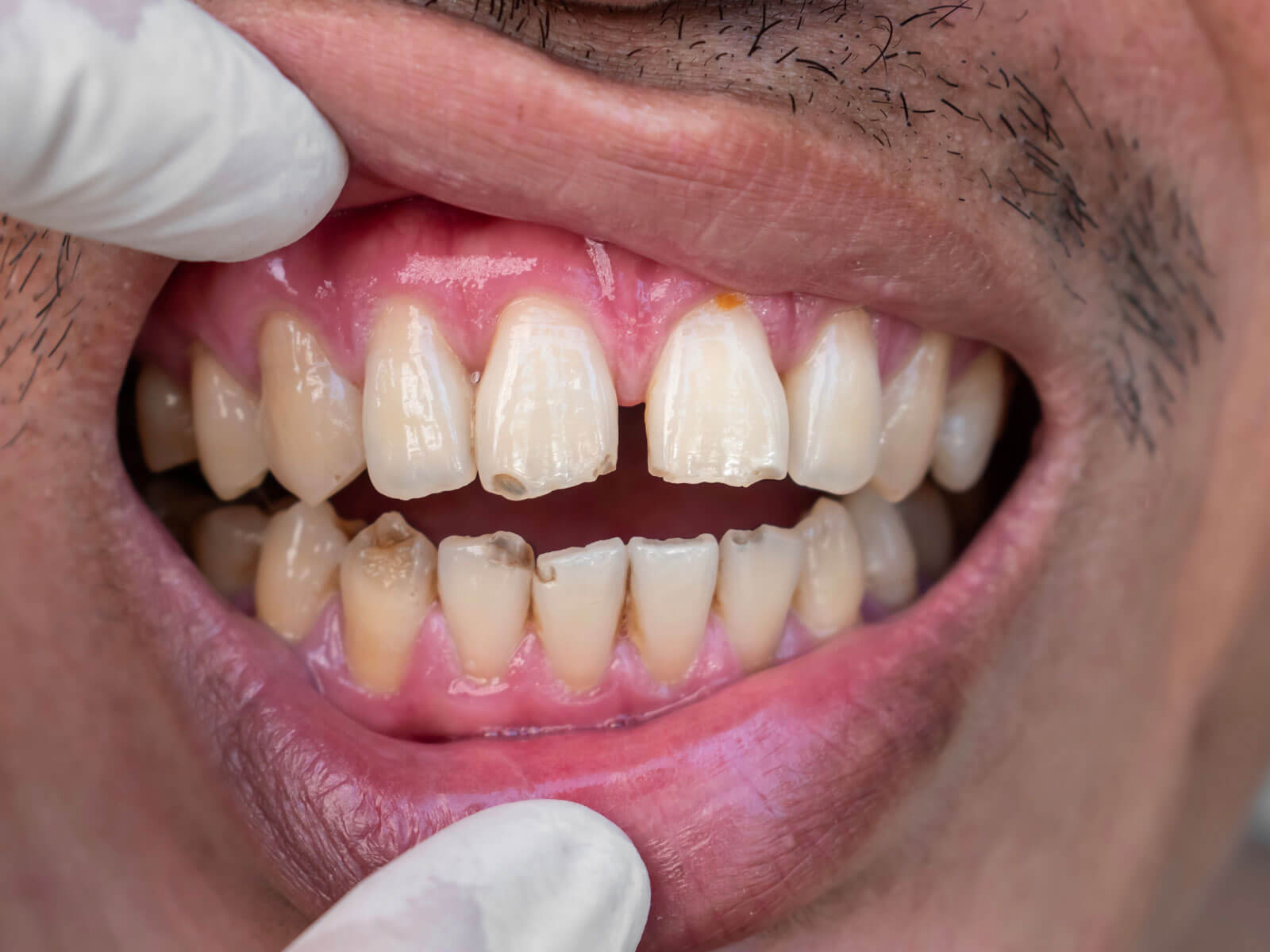 Impacted Teeth: Causes, Symptoms & Treatment Options